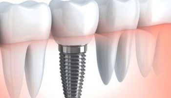 top dentist in Noida 59, top dentist Noida 66, best dental implant mamura